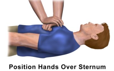 Chest Compressions for Cardiac Arrest